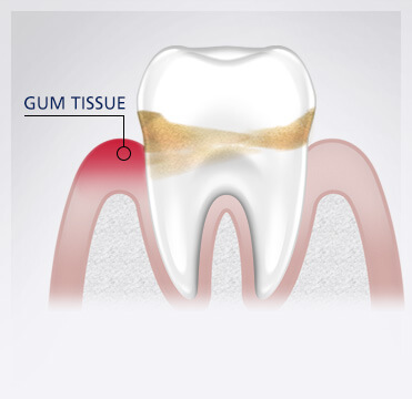 Parodontax receding gums